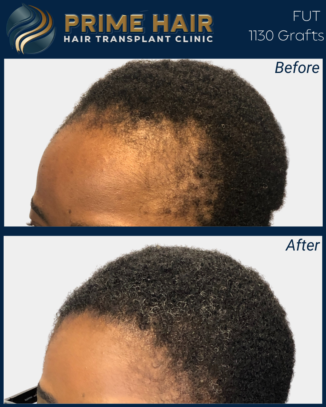 Before and after images showing the results of hair transplant procedures. The top image shows thinning hair with sparse density, while the bottom image shows fuller, thicker hair after treatment.