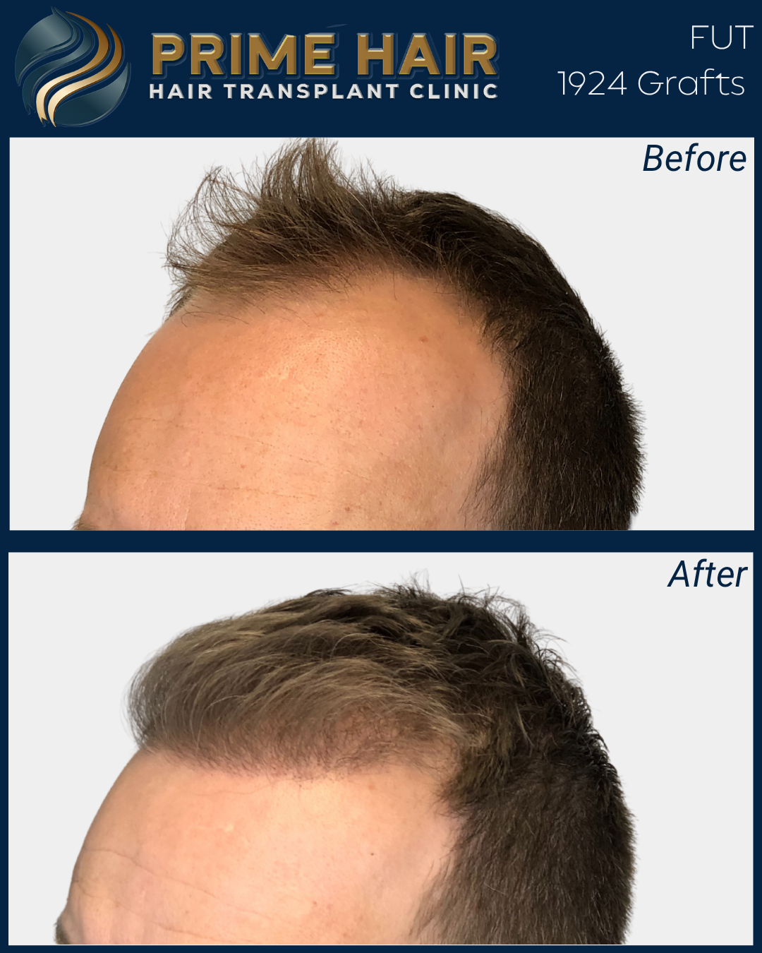 Before and after photos of a man showing hair restoration results from Prime Hair Hair Transplant Clinic with 1924 grafts.
