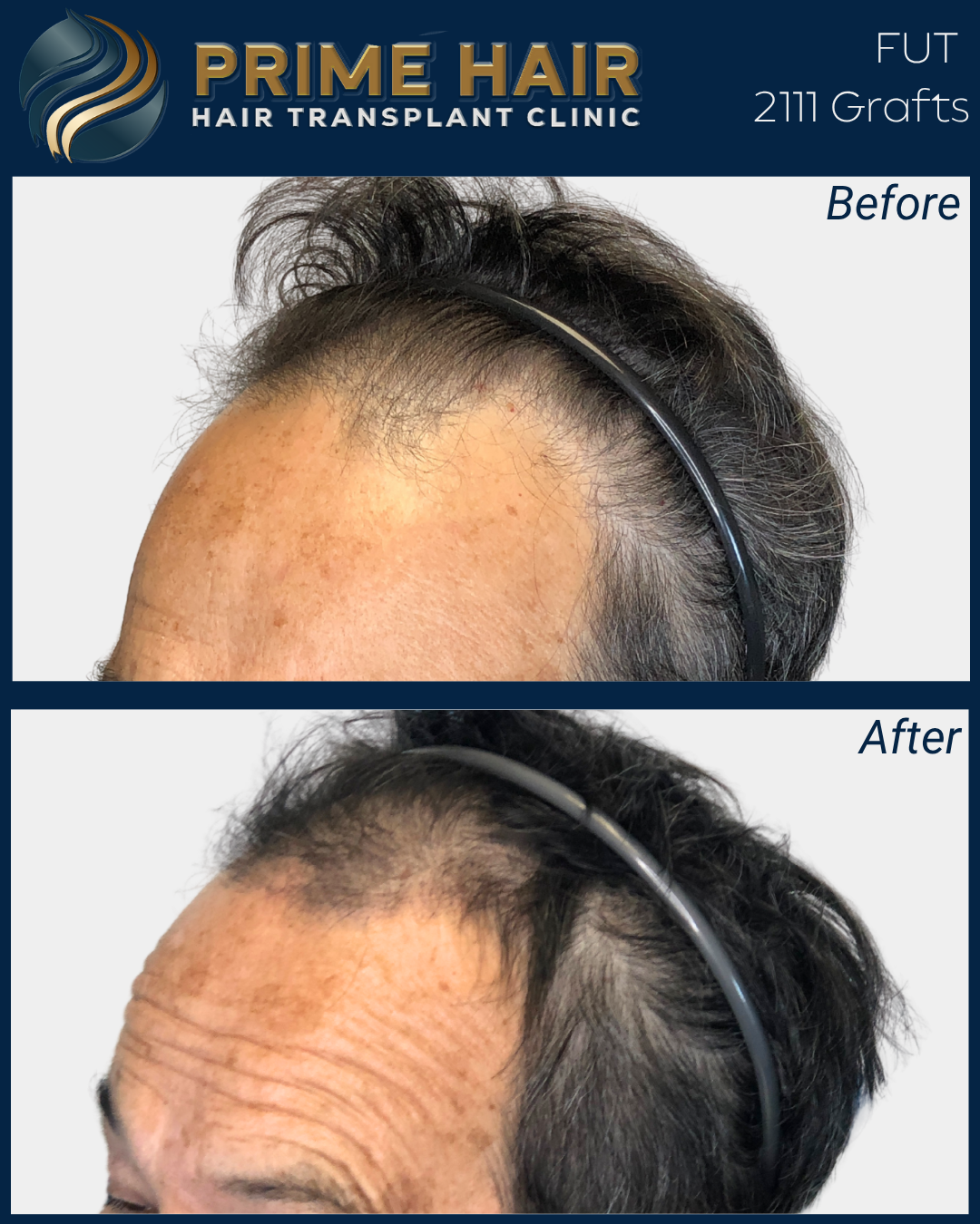 Before and after photos of a man's hair transplant showing scalp before and after grafting at Prime Hair Hair Transplant Clinic.