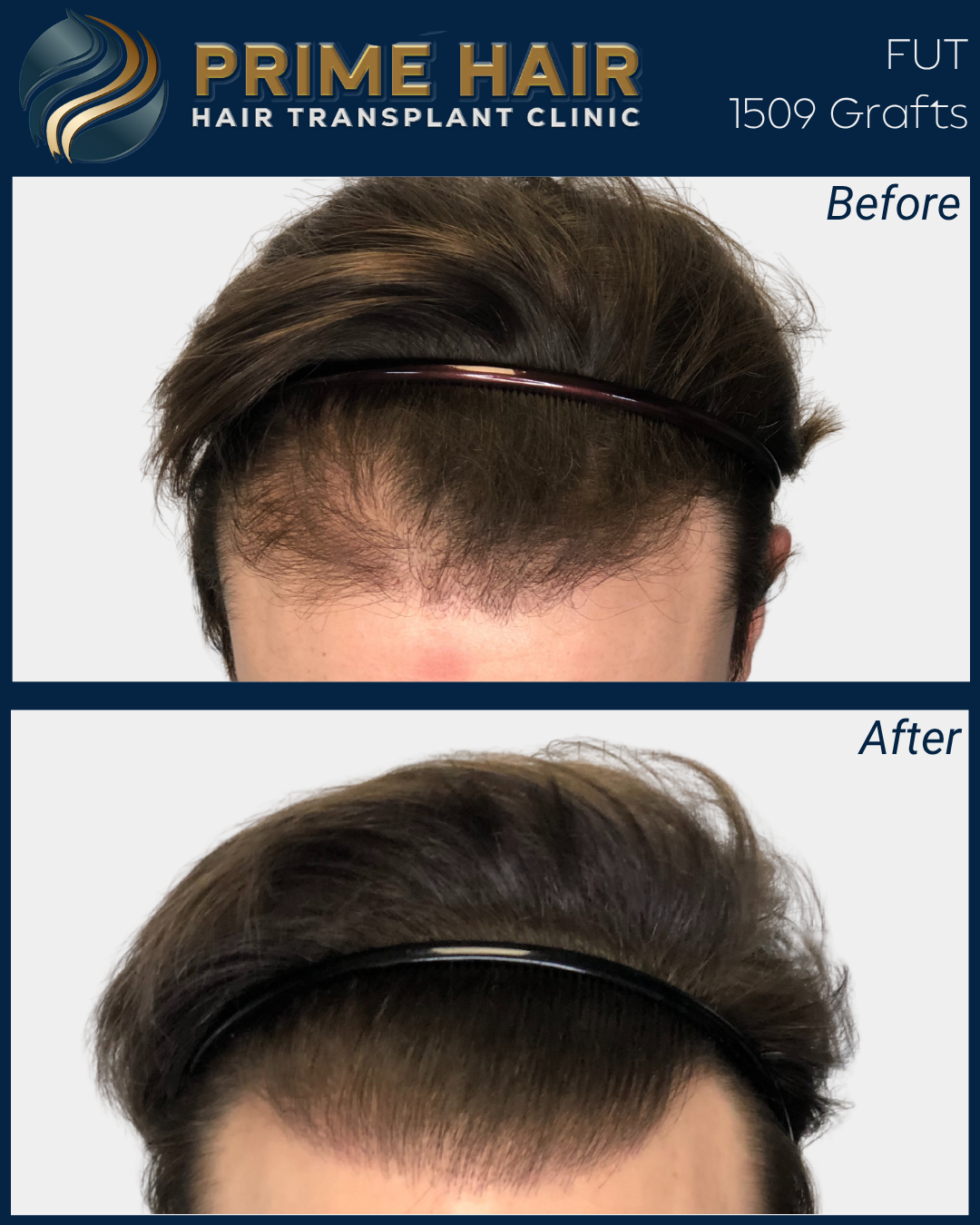 Before and after photos of a man who received a hair transplant at Prime Hair Hair Transplant Clinic. The before photo shows thinning hair on top of the head, while the after photo shows a fuller hairline with improved density.