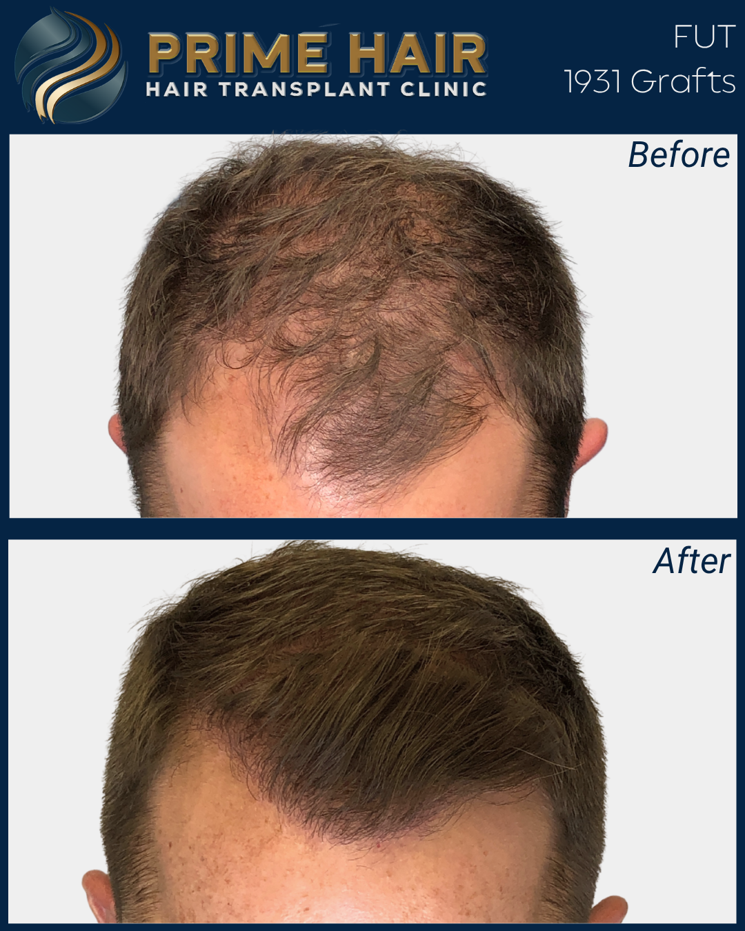 Before and after images of a man's scalp showing hair restoration with grafts from Prime Hair Hair Transplant Clinic.