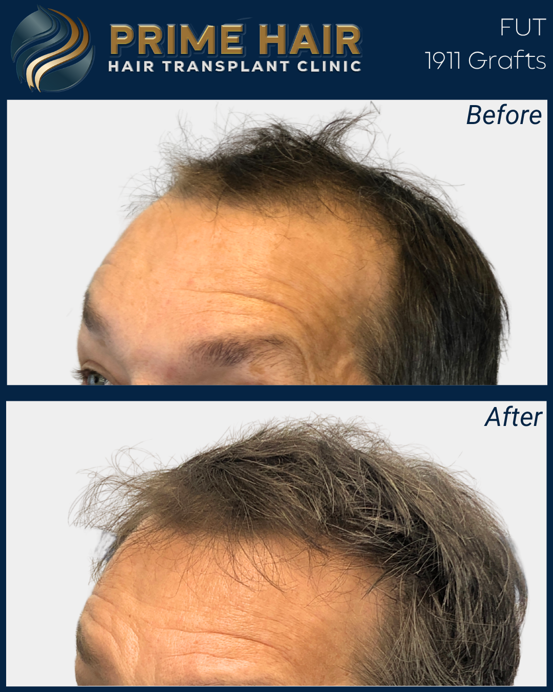 Before and after images showing a man's scalp with hair loss, with the after photo displaying a fuller head of hair after a hair transplant at Prime Hair Hair Transplant Clinic.