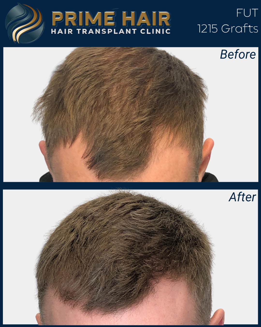 Before and after images showing hair restoration with 1215 grafts at Prime Hair Hair Transplant Clinic.