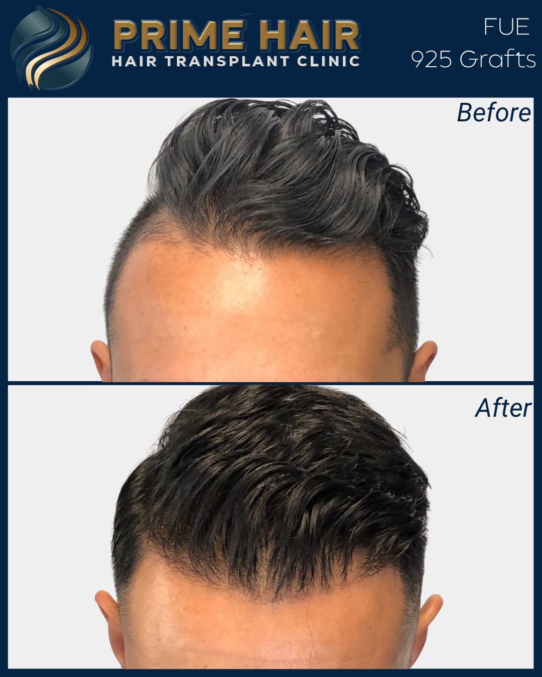 Before and after images of a man's hair showing a hair transplant at Prime Hair Hair Transplant Clinic, highlighting improved hair density and style post-procedure.