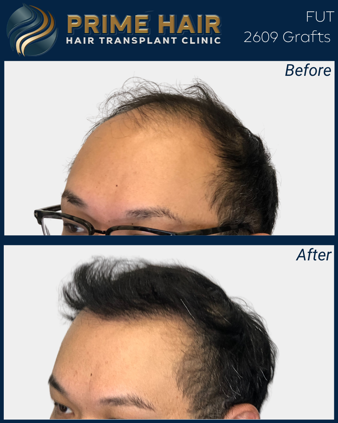 Before and after images showing a man's scalp, with a significant increase in hair density and volume after a hair transplant procedure at Prime Hair Hair Transplant Clinic.