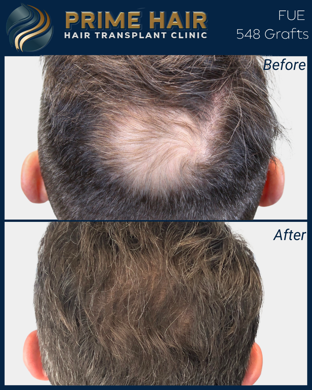 Before and after photos showing hair restoration with PRP treatment, with a focus on the top of a man's head, from crown to hairline.