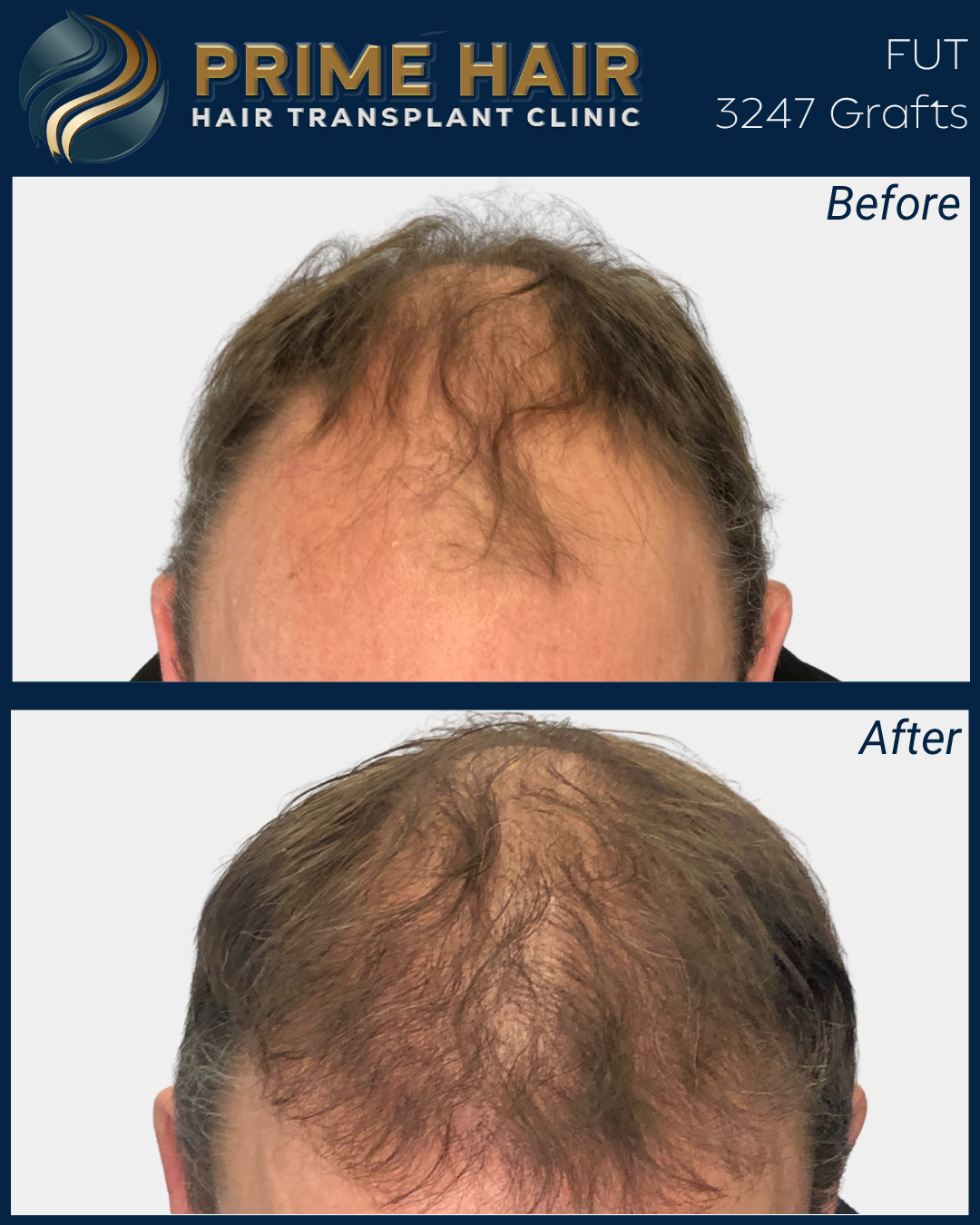 Before and after images showing a man with hair restoration, with the top image labeled "Before" showing thinning hair and the bottom image labeled "After" showing increased hair density from a hair transplant at Prime Hair Hair Transplant Clinic.