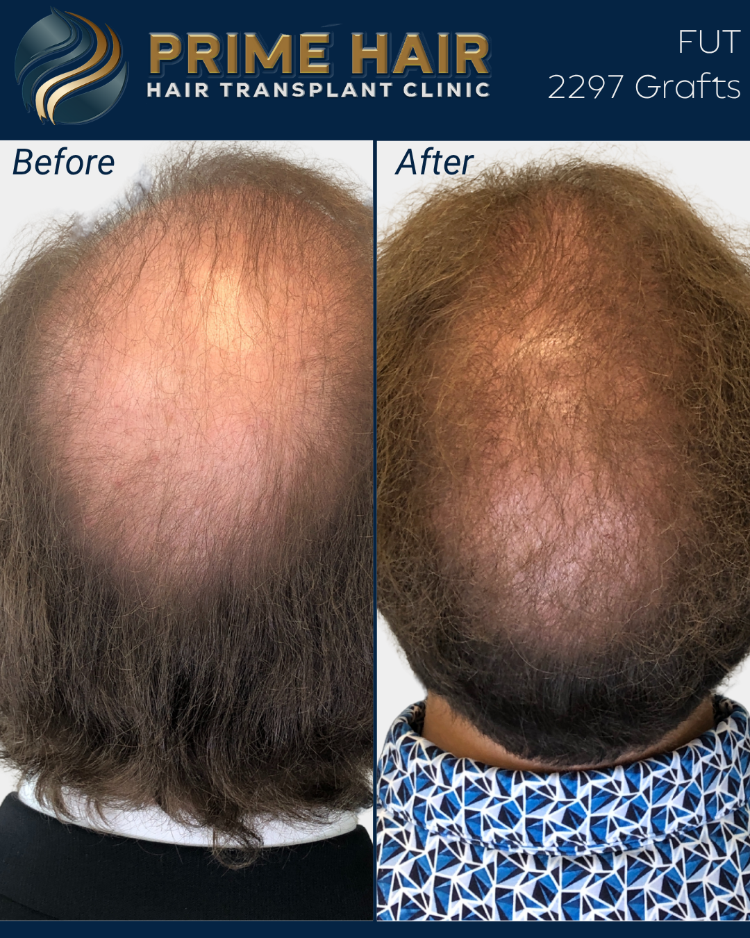 Comparison of a man's scalp on a before and after hair transplant, showing increased hair density and coverage on the top of his head.