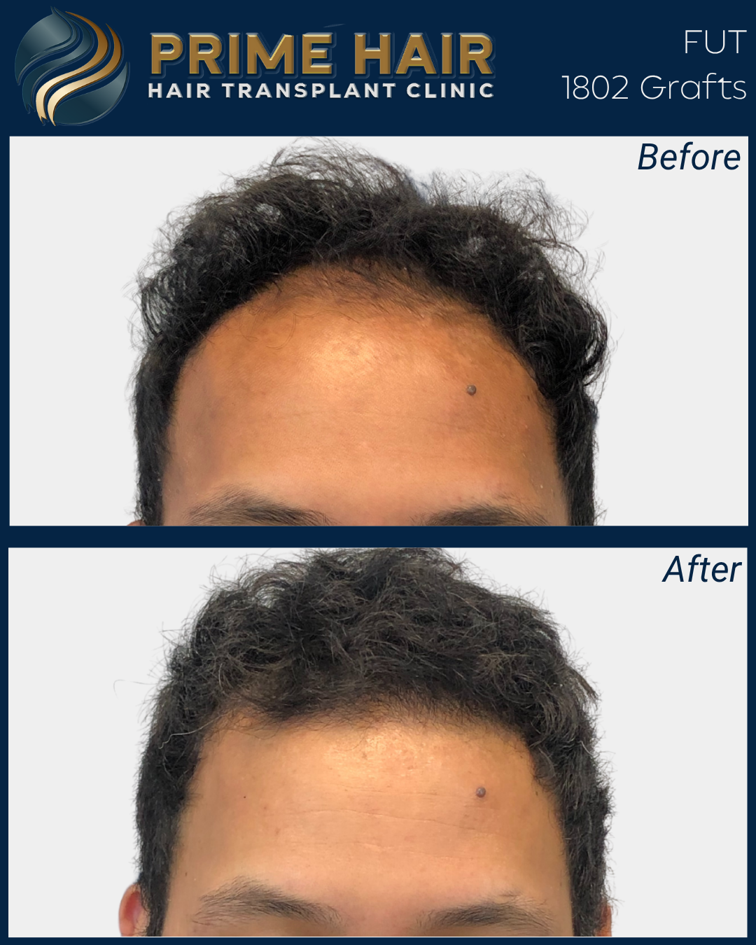 Comparison of a person's hair before and after hair transplant at Prime Hair Hair Transplant Clinic. The top image shows thinning hair, and the bottom image shows fuller, thicker hair after the procedure.