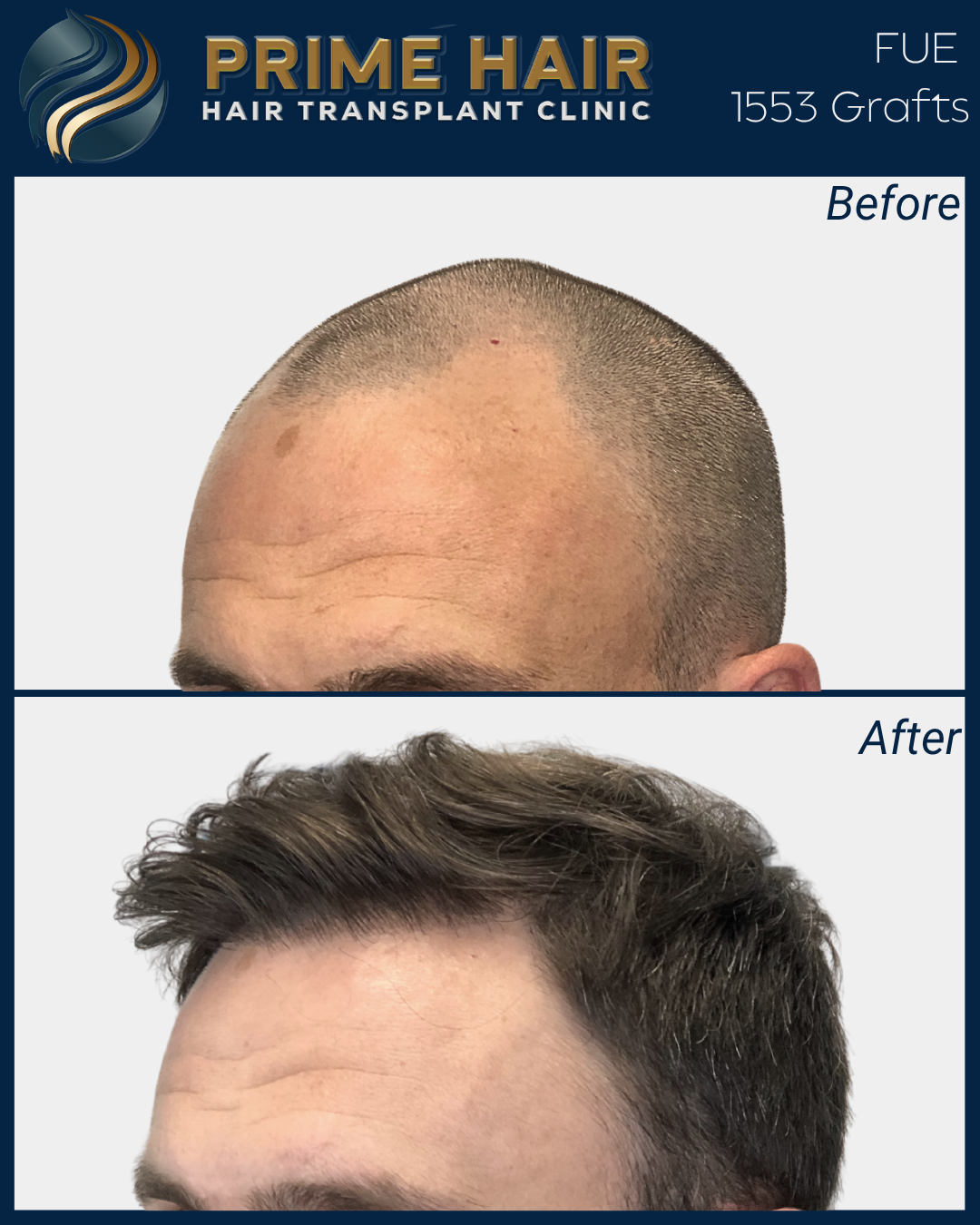Before and after photos of a man's hair transplant. The top image shows a bald scalp with very little hair. The bottom image shows a fuller head of styled, thick hair after the procedure.