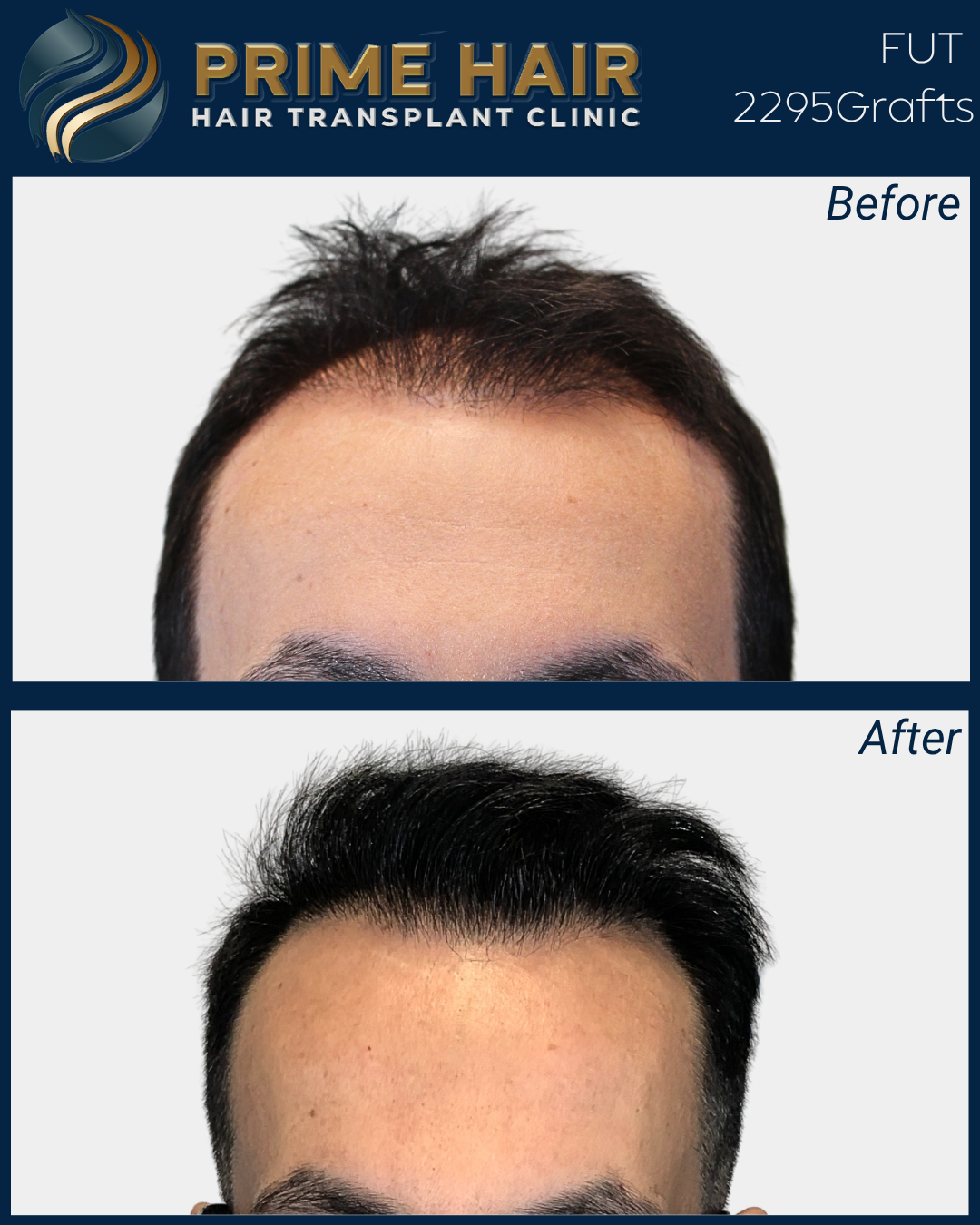 Before and after photos of a man showing hair transplant results, with the top image labeled "Before" and the bottom labeled "After".