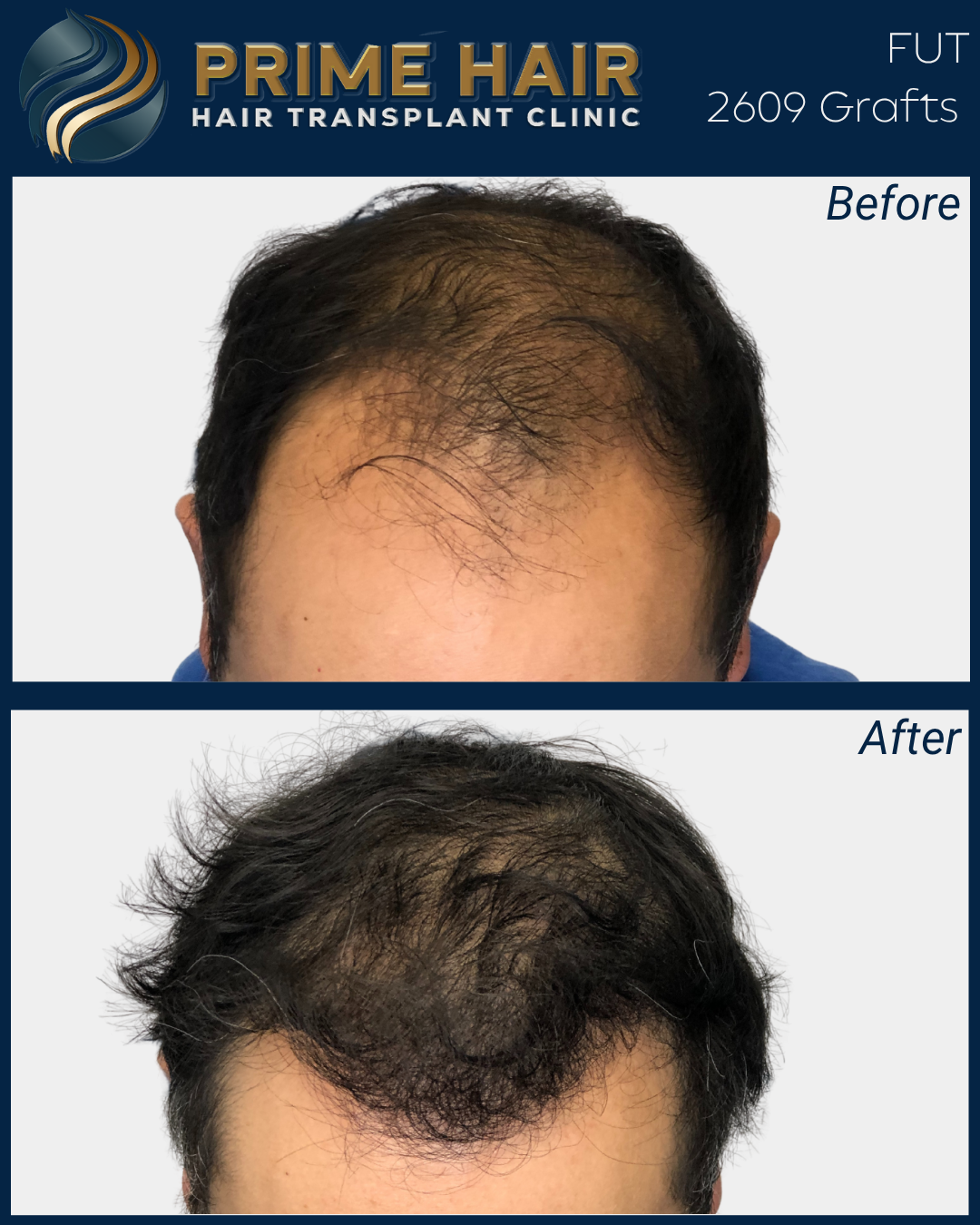 Before and after images showing hair restoration, with the before image displaying bald spots and thinning hair, and the after image showing fuller, thicker hair after a hair transplant at Prime Hair Clinic.