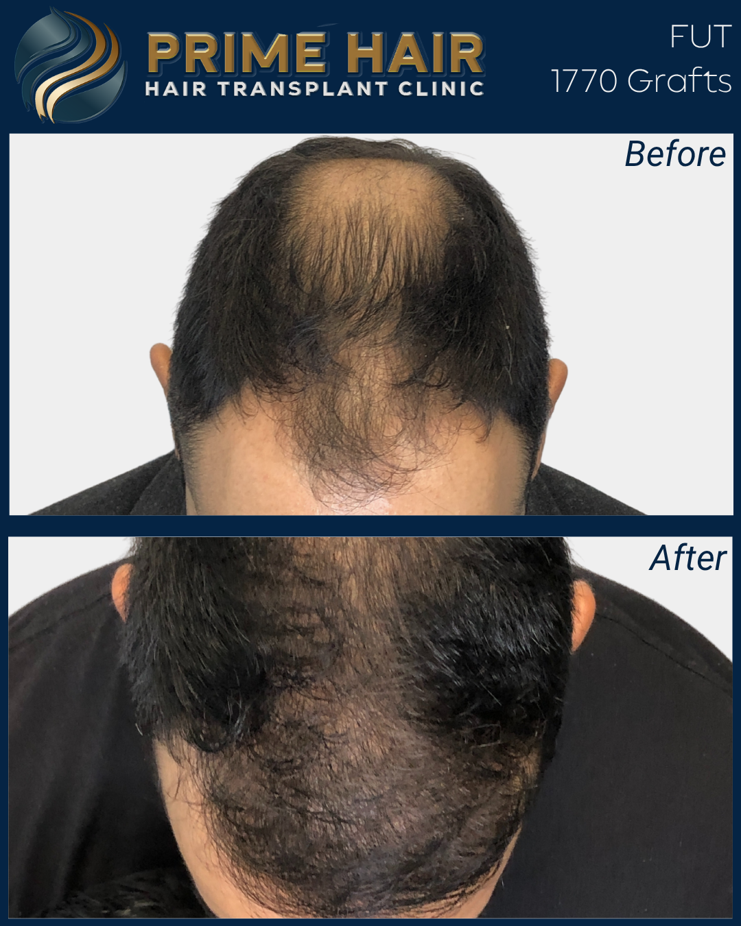 Before and after photos of a man's scalp showing hair restoration results from PRP hair transplant at Prime Hair Clinic.