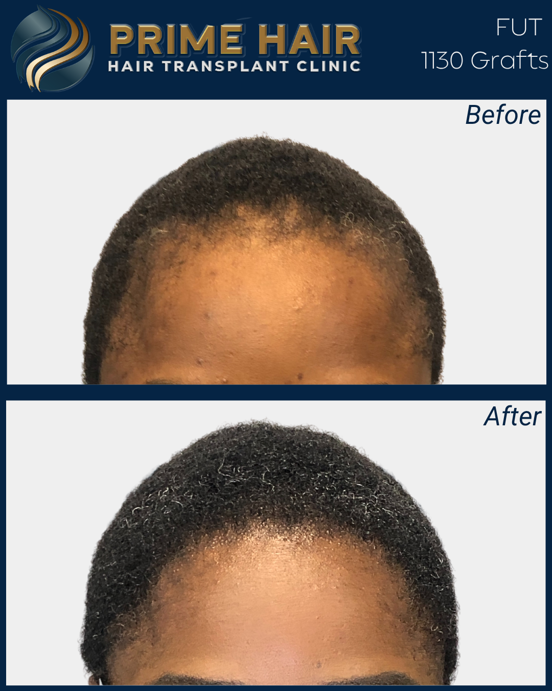 Progress photos showing a person's scalp before and after hair transplant treatment. The 'Before' image shows thinning hair, while the 'After' image shows a fuller, denser hairline with new hair growth.