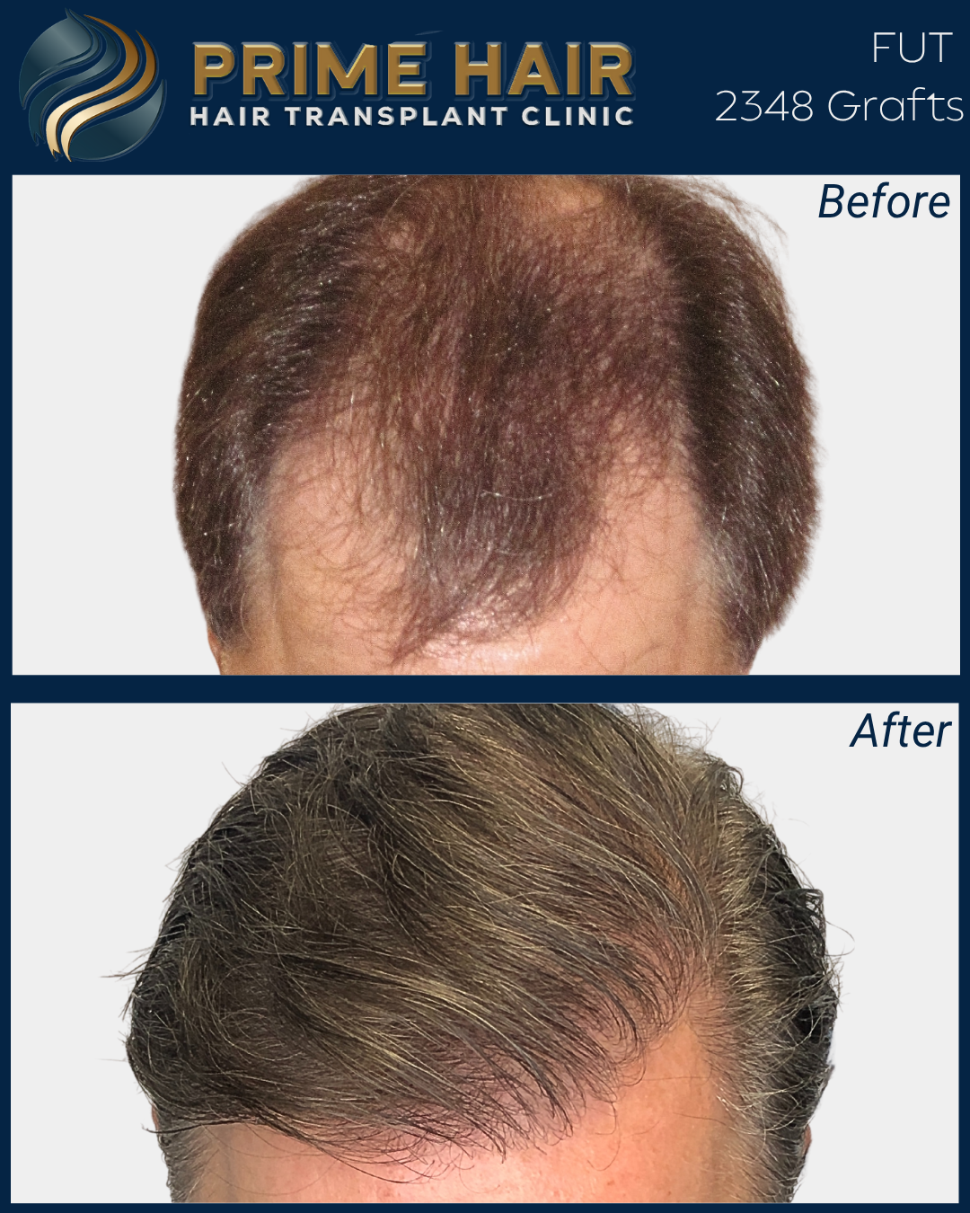 Before and after images showing a man's scalp with hair transplant results. The top image depicts thinning hair and hair loss, while the bottom image shows a fuller, thicker head of hair after hair transplant treatment.