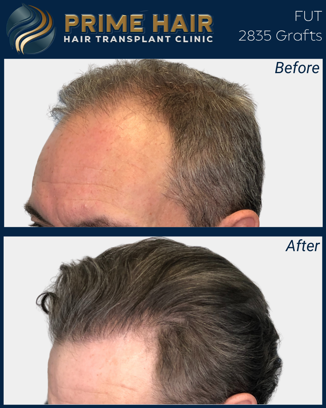 Before and after images of a man's hair showing a hair transplant. The "before" image shows thinning hair on the top and front of the scalp. The "after" image shows fuller, thicker hair with a natural hairstyle.