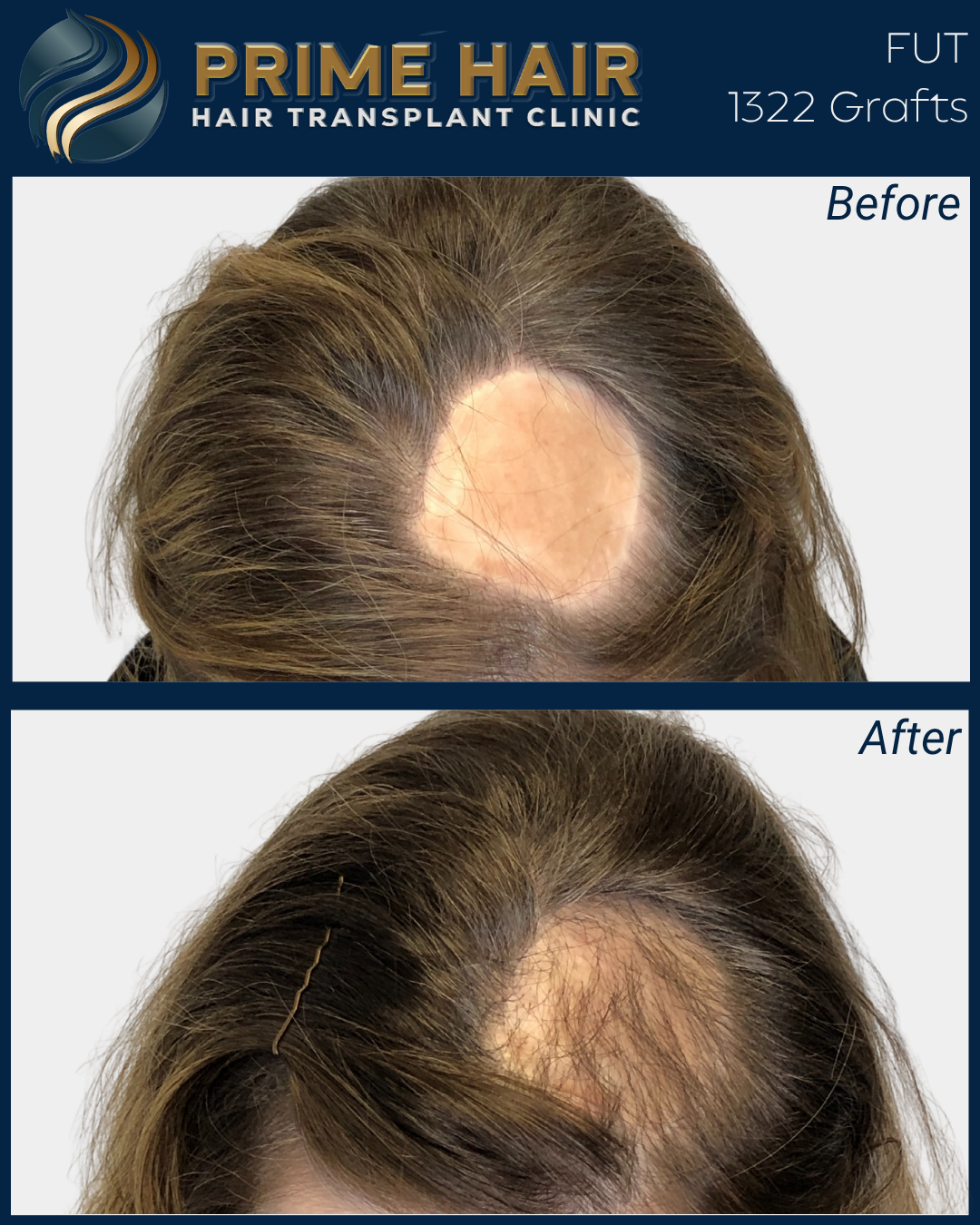 Before and after photos of a woman's scalp showing hair transplant results, with the top image labeled 'Before' showing hair loss and the bottom image labeled 'After' showing improved hair coverage.