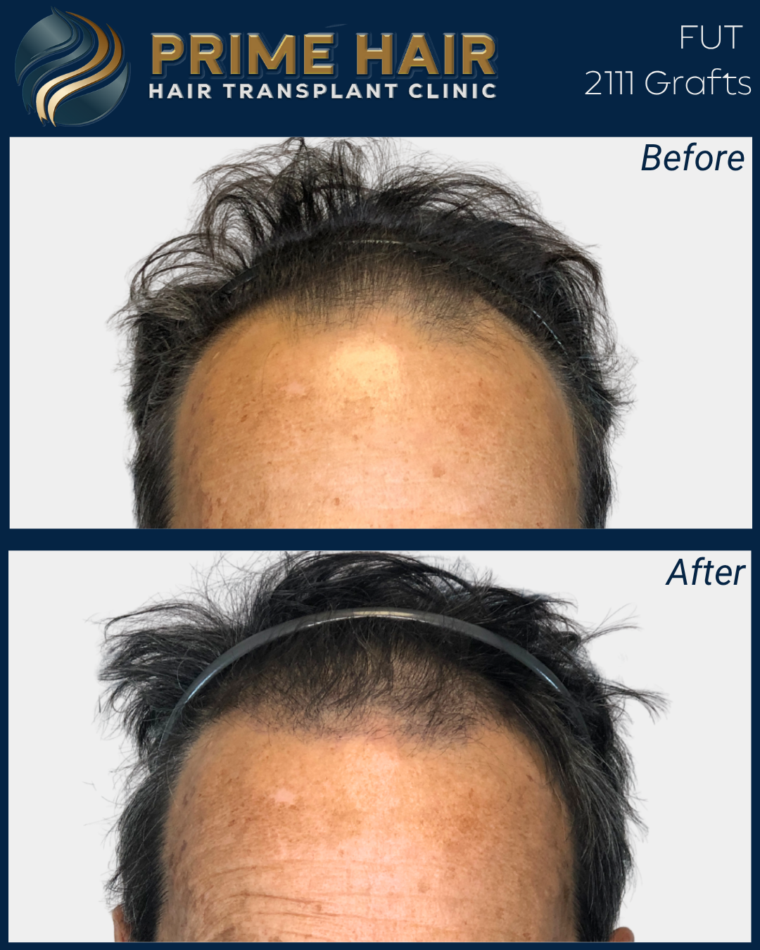 Before and after images showing hair restoration results from Prime Hair Hair Transplant Clinic, featuring a man's forehead and hairline, with noticeable increased hair density after a transplant.