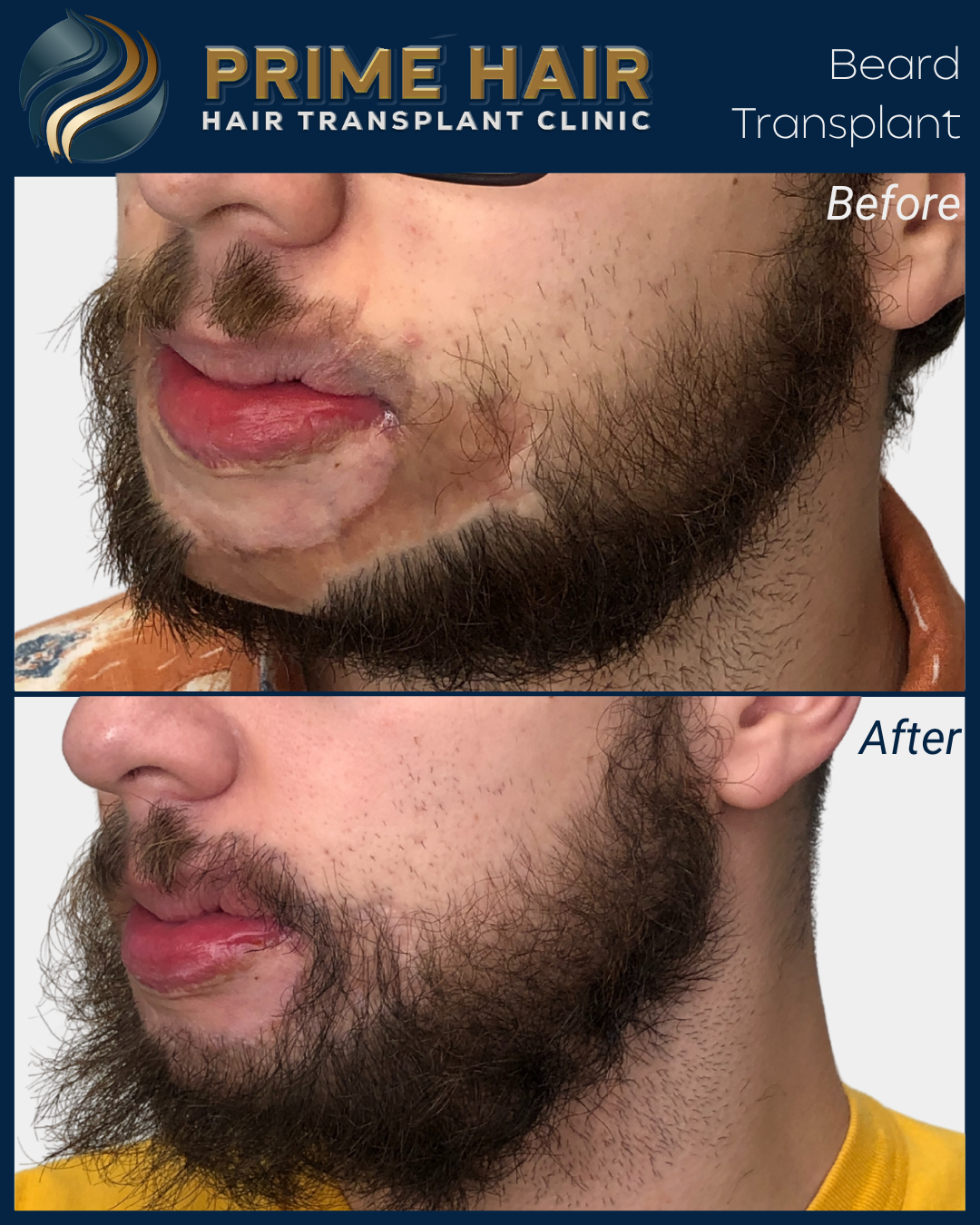 _MAIN B&A Facial Hair Template.png