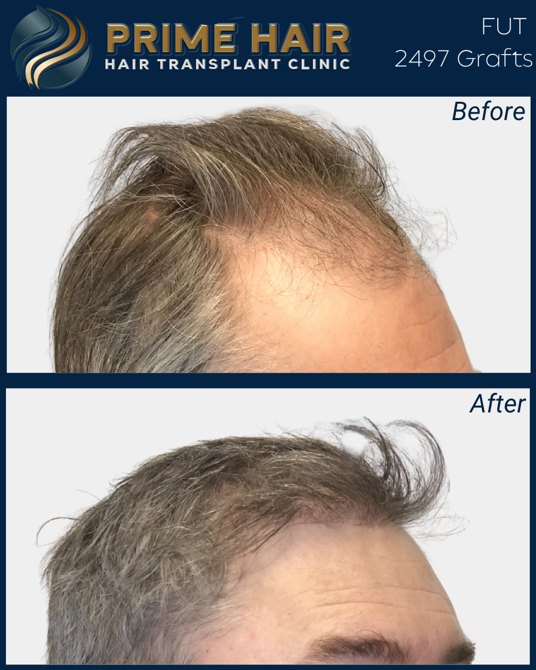 Comparison of before and after hair transplant, showing increased hair density and improved hairline in the after photo.