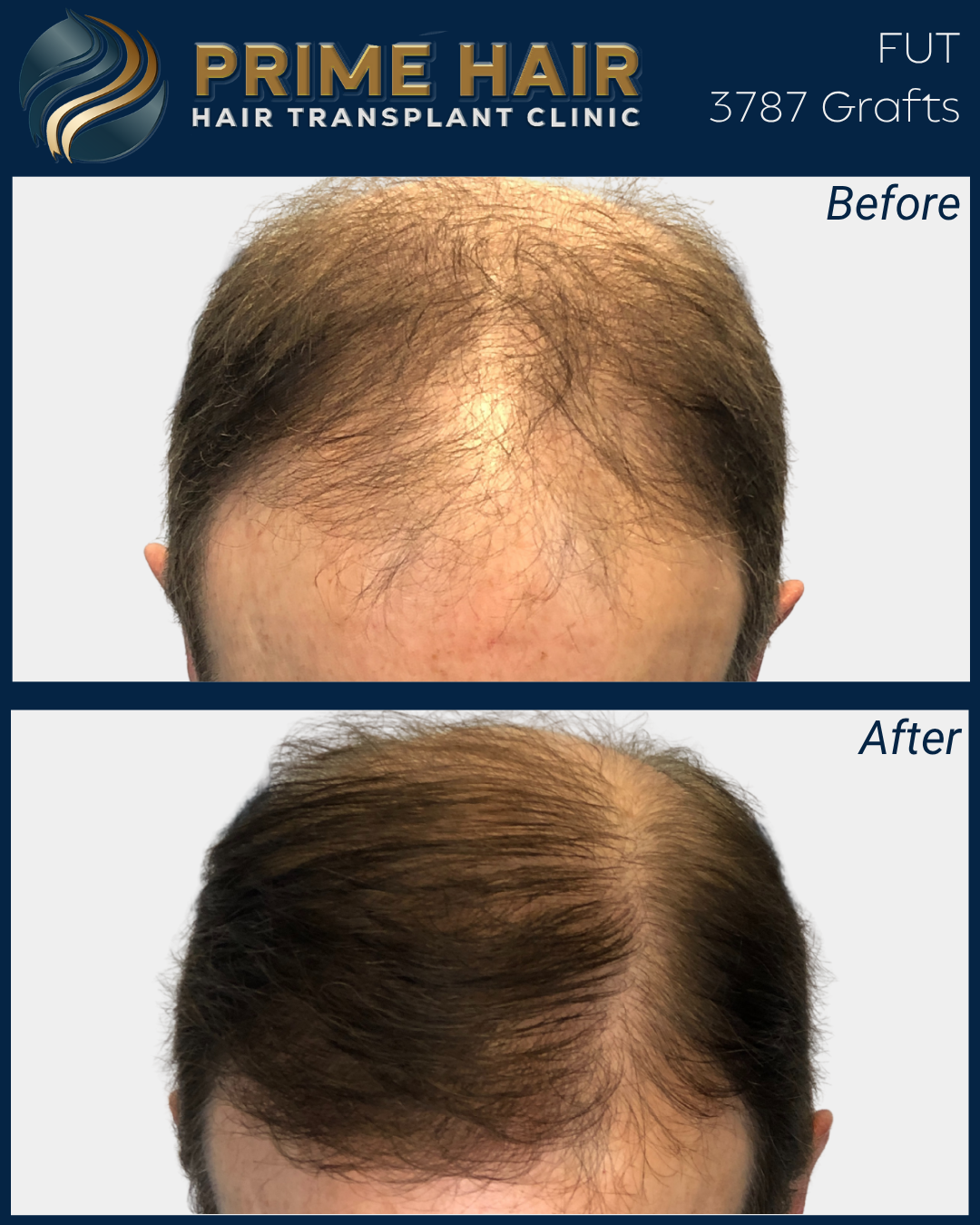 Before and after images showing hair restoration results from Prime Hair Hair Transplant Clinic, with the top image labeled 'Before' showing thinning hair and the bottom image labeled 'After' showing thicker, fuller hair.