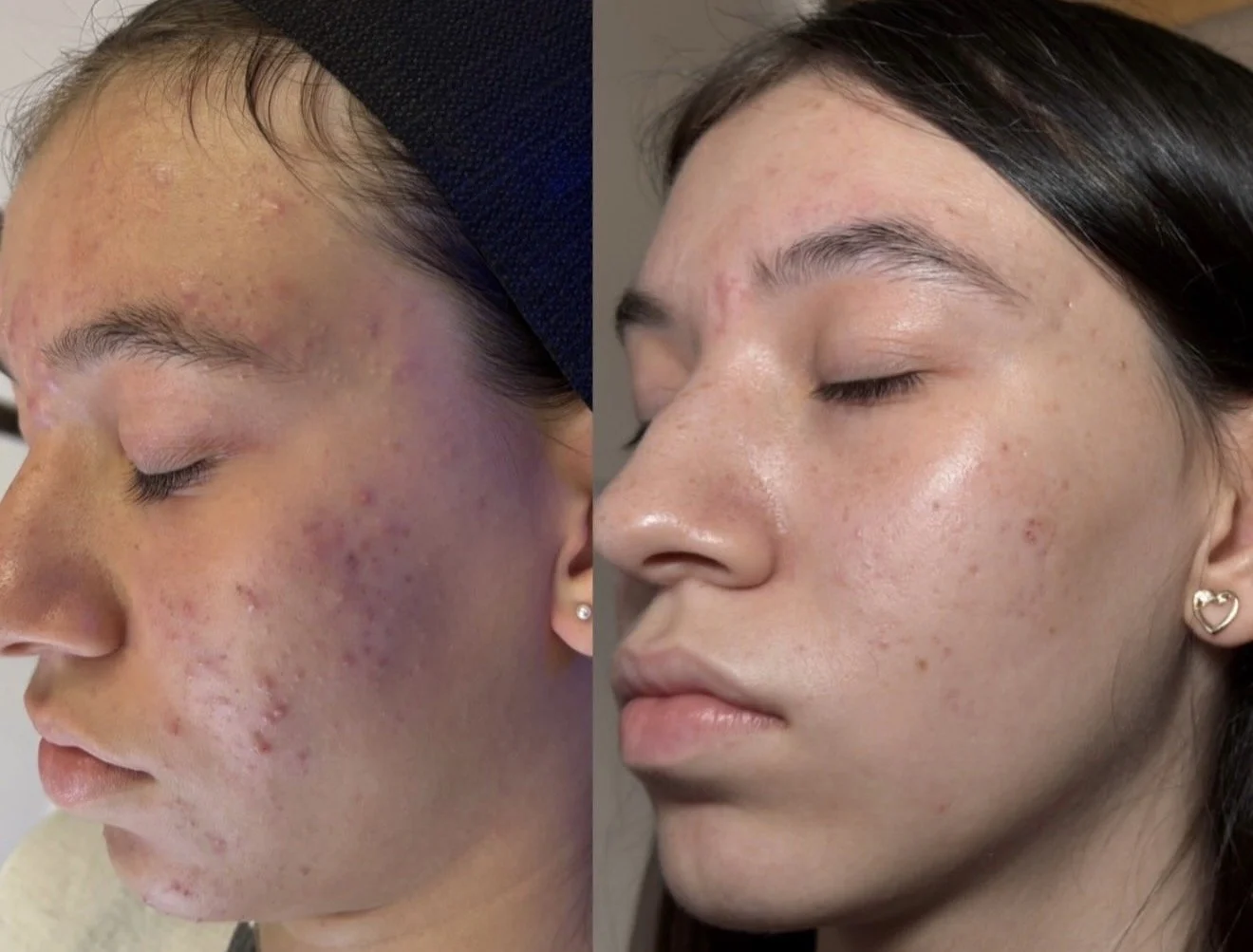 Before and after Acne Bootcamp results at Sylk Aesthetic Collective