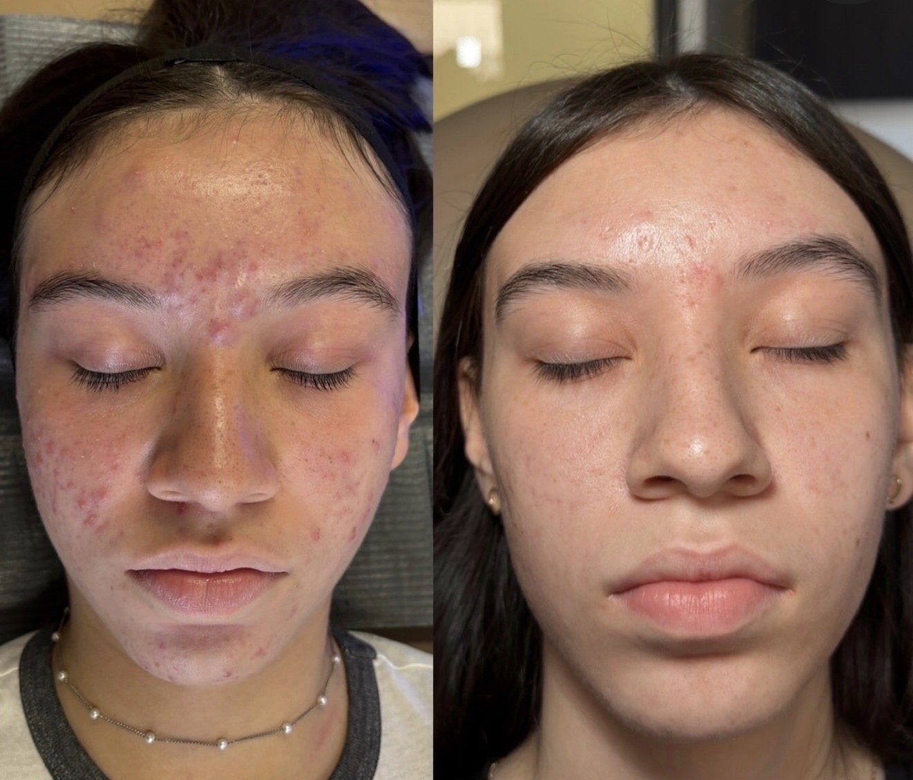 Before and after Acne Bootcamp results at Sylk Aesthetic Collective
