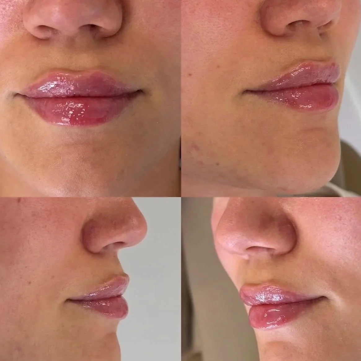 Before and after lip filler results at Sylk Aesthetic Collective