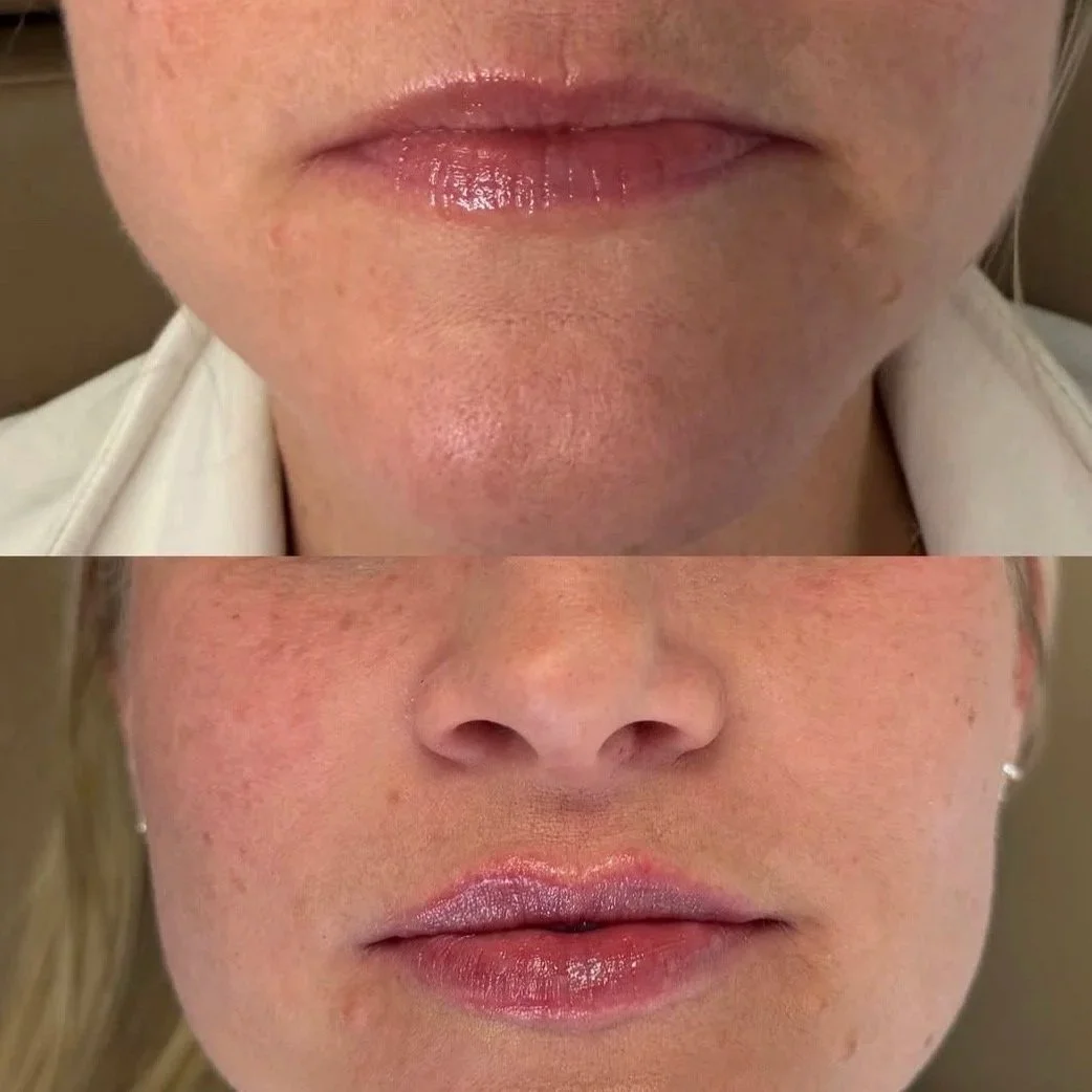 Before and after lip filler results at Sylk Aesthetic Collective