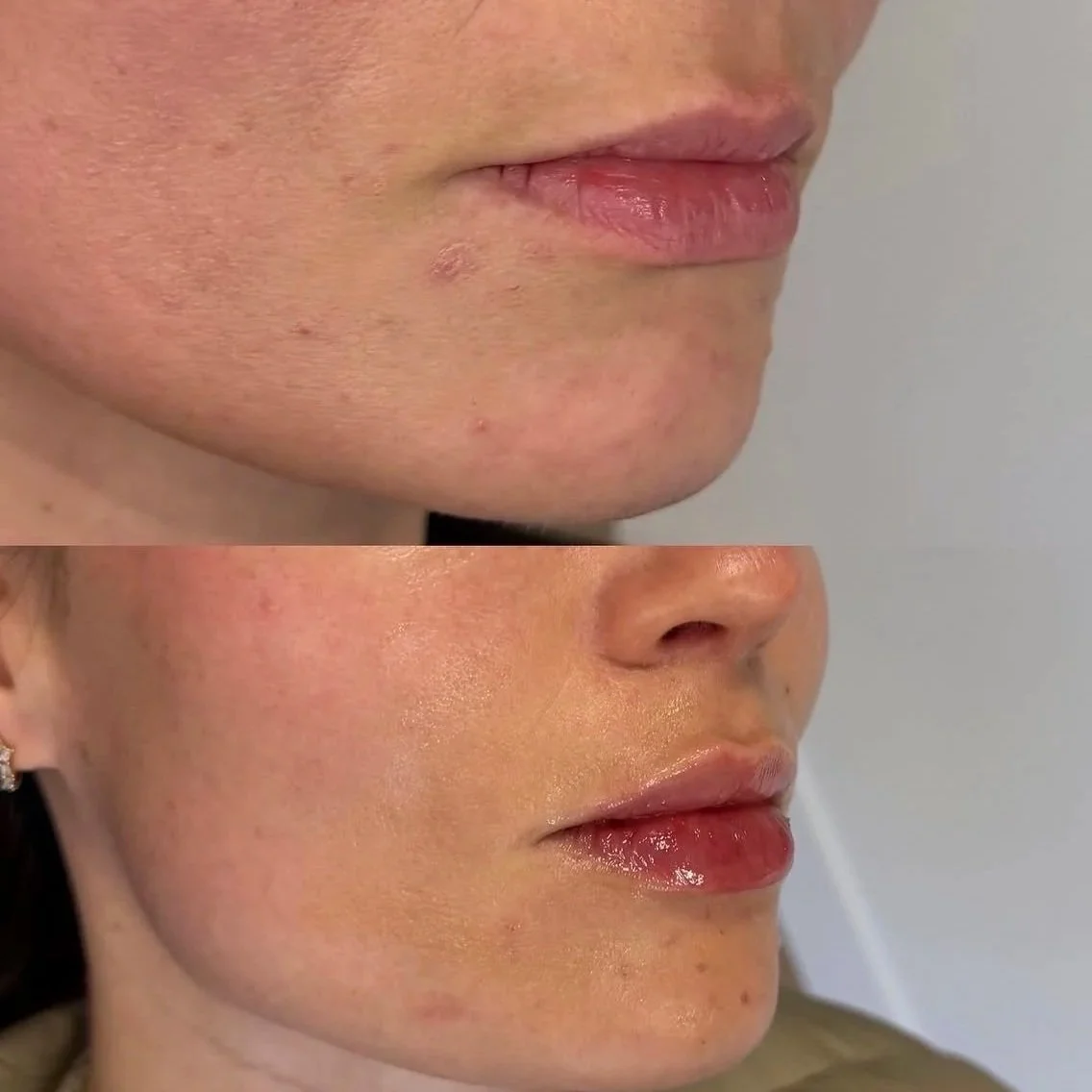Before and after lip filler results at Sylk Aesthetic Collective