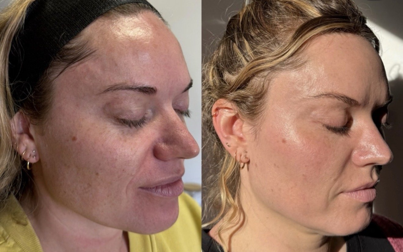 Before and after NouveDerm laser results at Sylk Aesthetic Collective