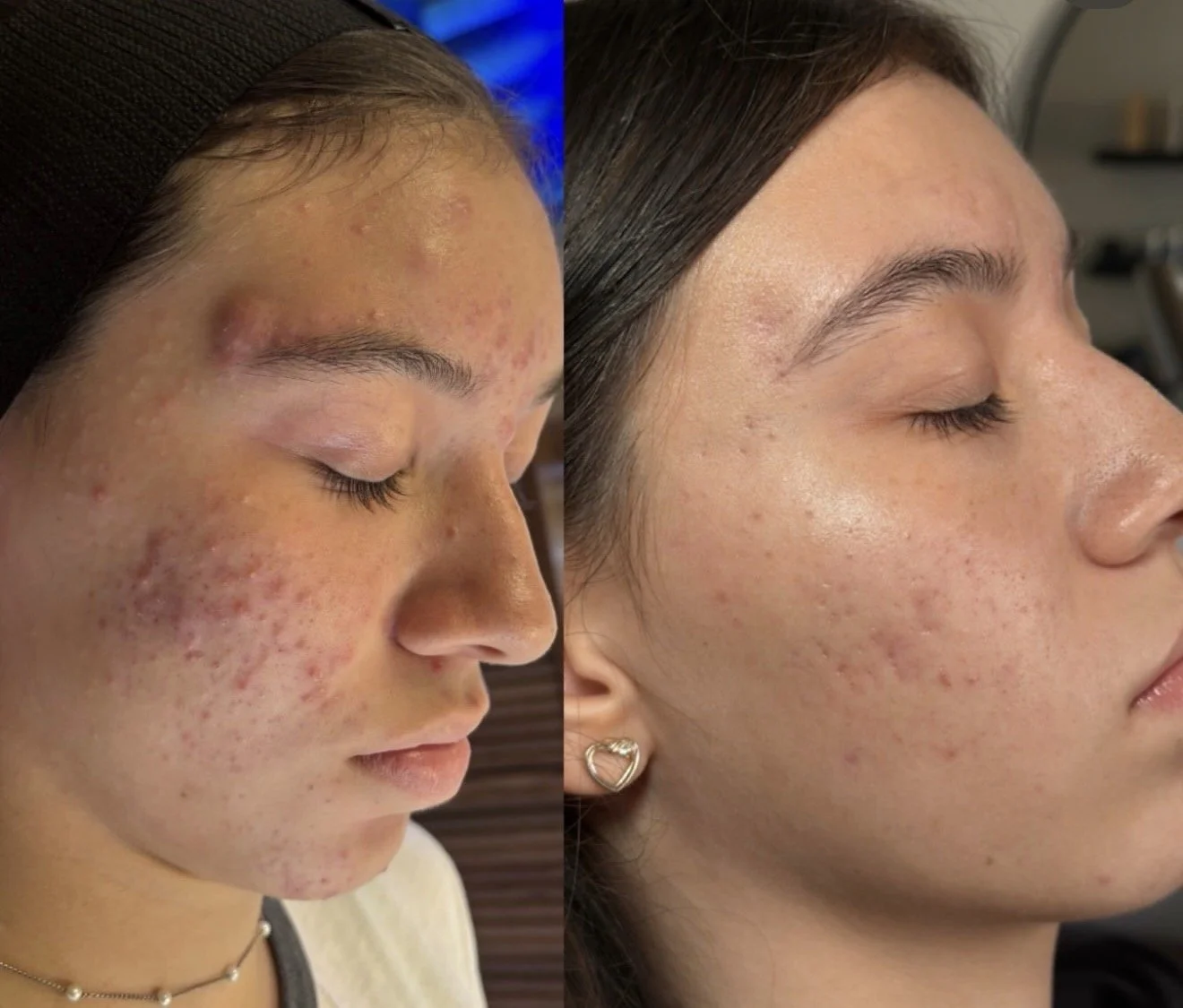 Before and after Acne Bootcamp results at Sylk Aesthetic Collective
