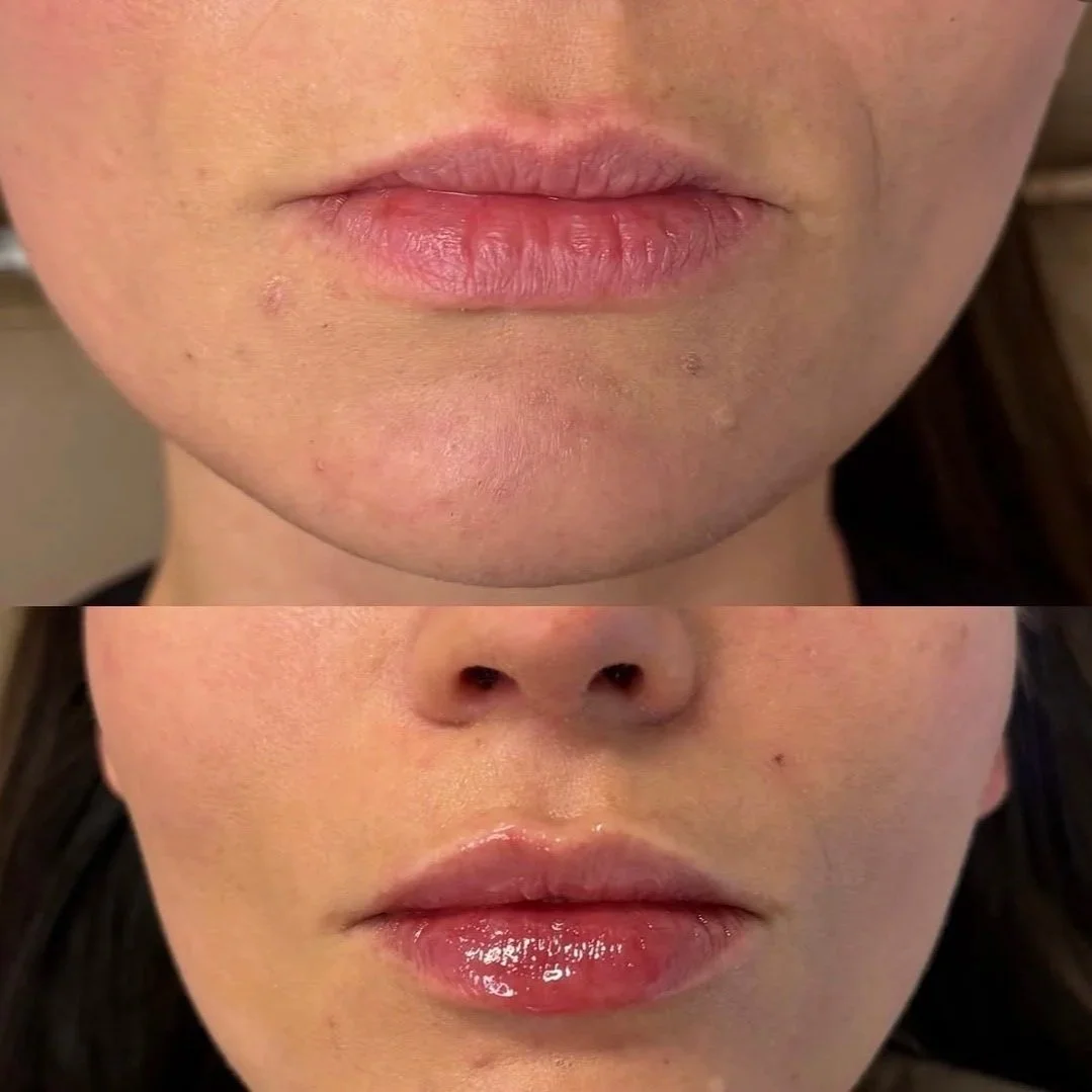 Before and after lip filler results at Sylk Aesthetic Collective