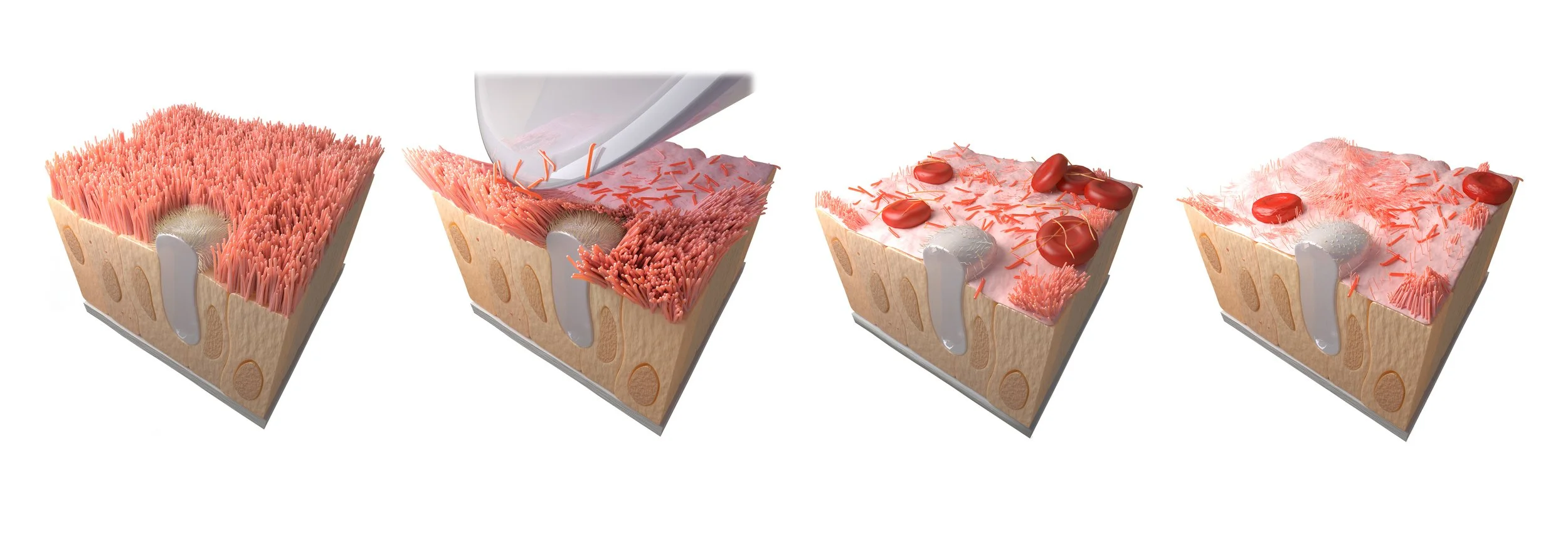 Tracheal lining damage