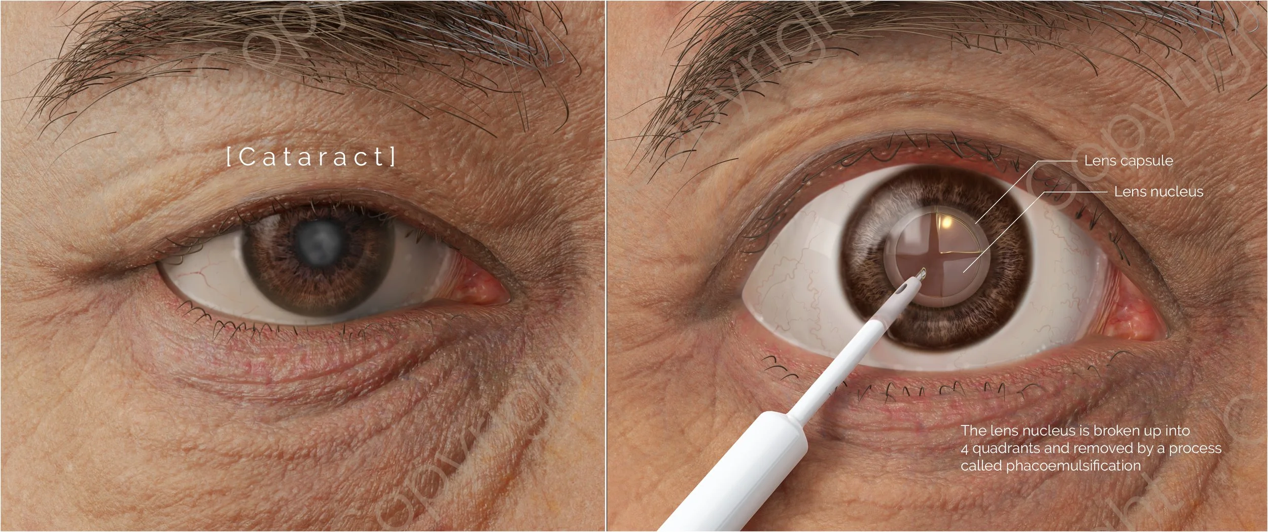 Cataract_ilustration2.jpg