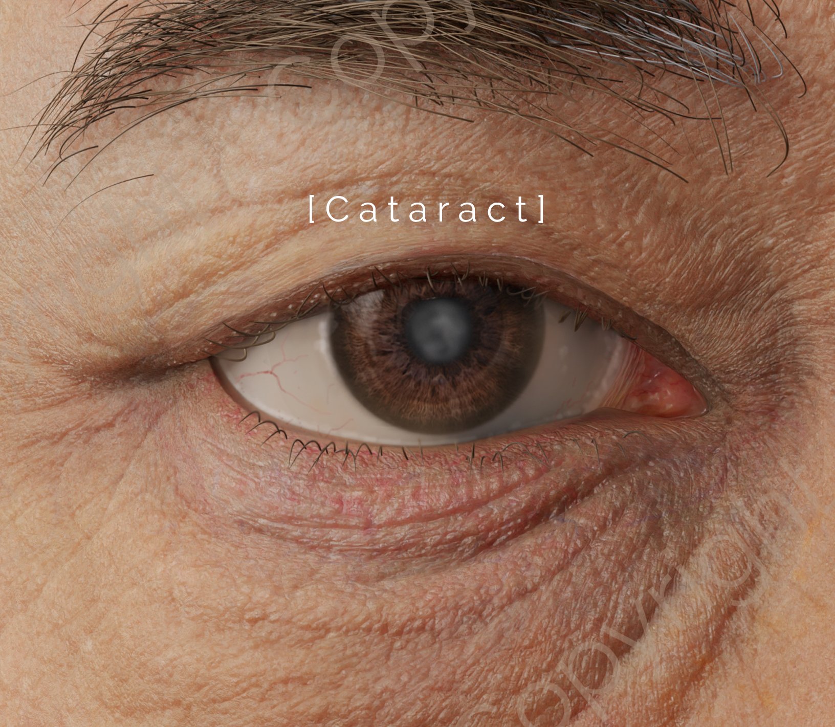 Cataract surgery