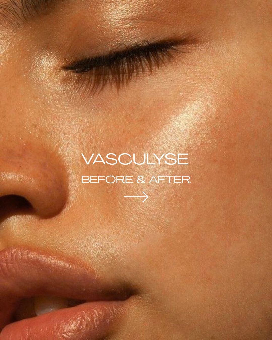 ✨ Spider Naevus &ndash; Immediately After 1st Vasculyse Session ✨

Instant results straight after treatment!

Vasculyse uses targeted thermocoagulation to deliver a precise microburst of energy directly into the dilated capillary. The vessel is coagu
