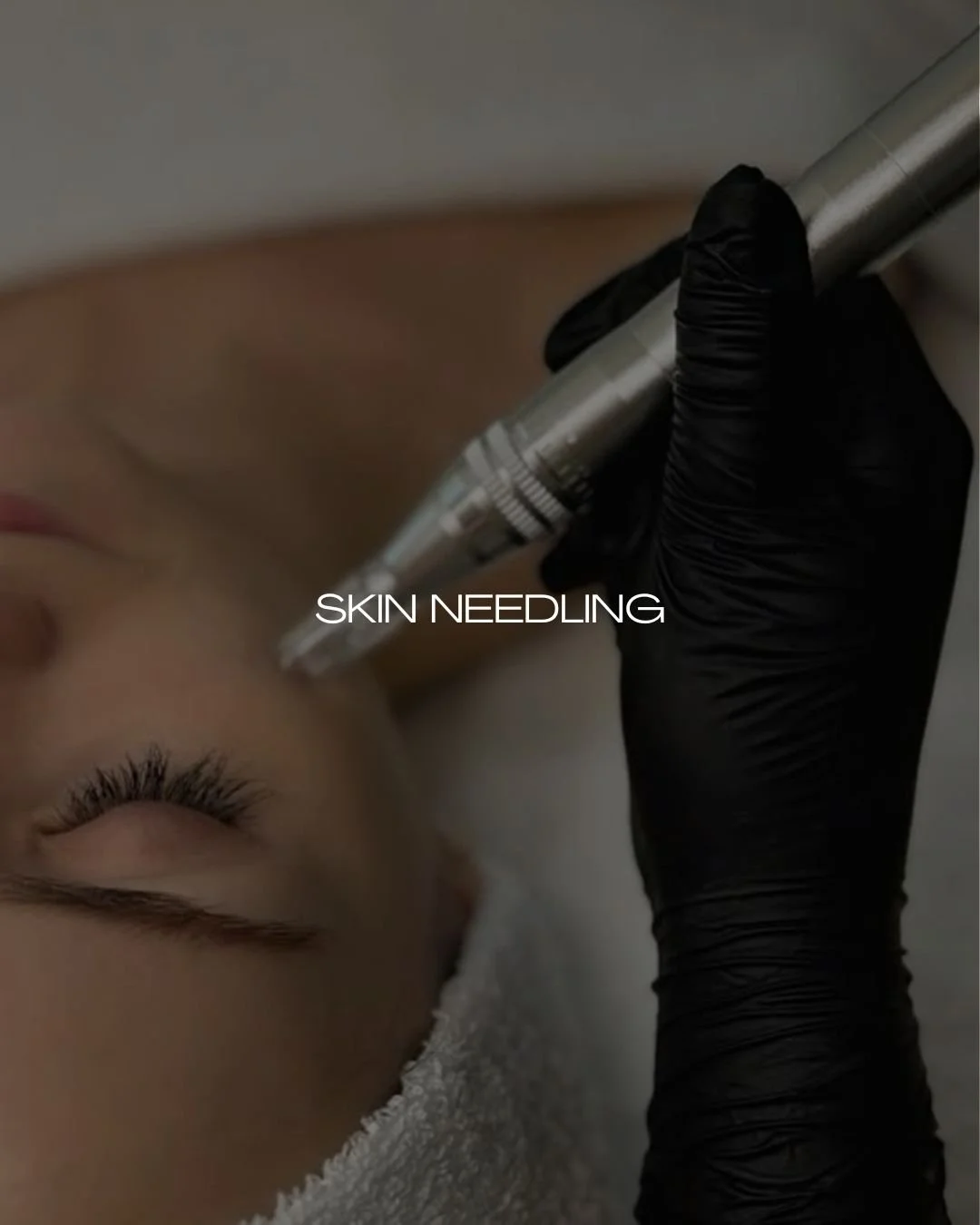 Skin Needling &mdash; boosting your skin from within 🤍

Also known as microneedling, this treatment uses tiny, controlled micro-channels to stimulate your skin&rsquo;s natural repair process.

The benefits include:
-Improved skin texture and tone
-R