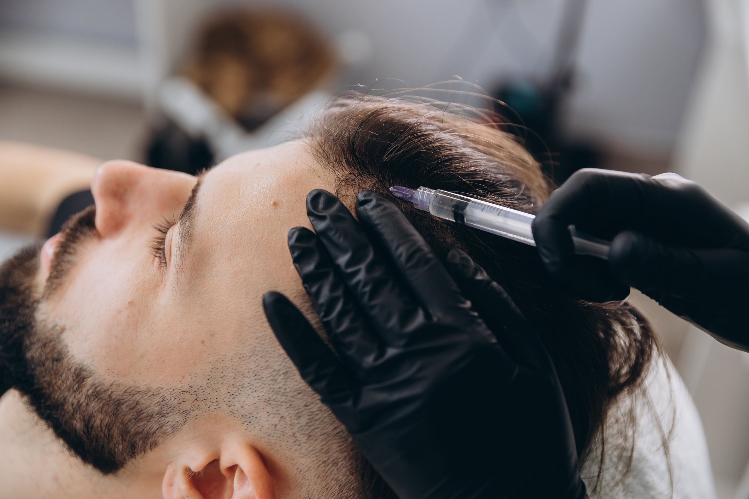 Un homme reçoit une injection dans le cuir chevelu lors d'une procédure de greffe de cheveux, réalisée par un professionnel portant des gants noirs.