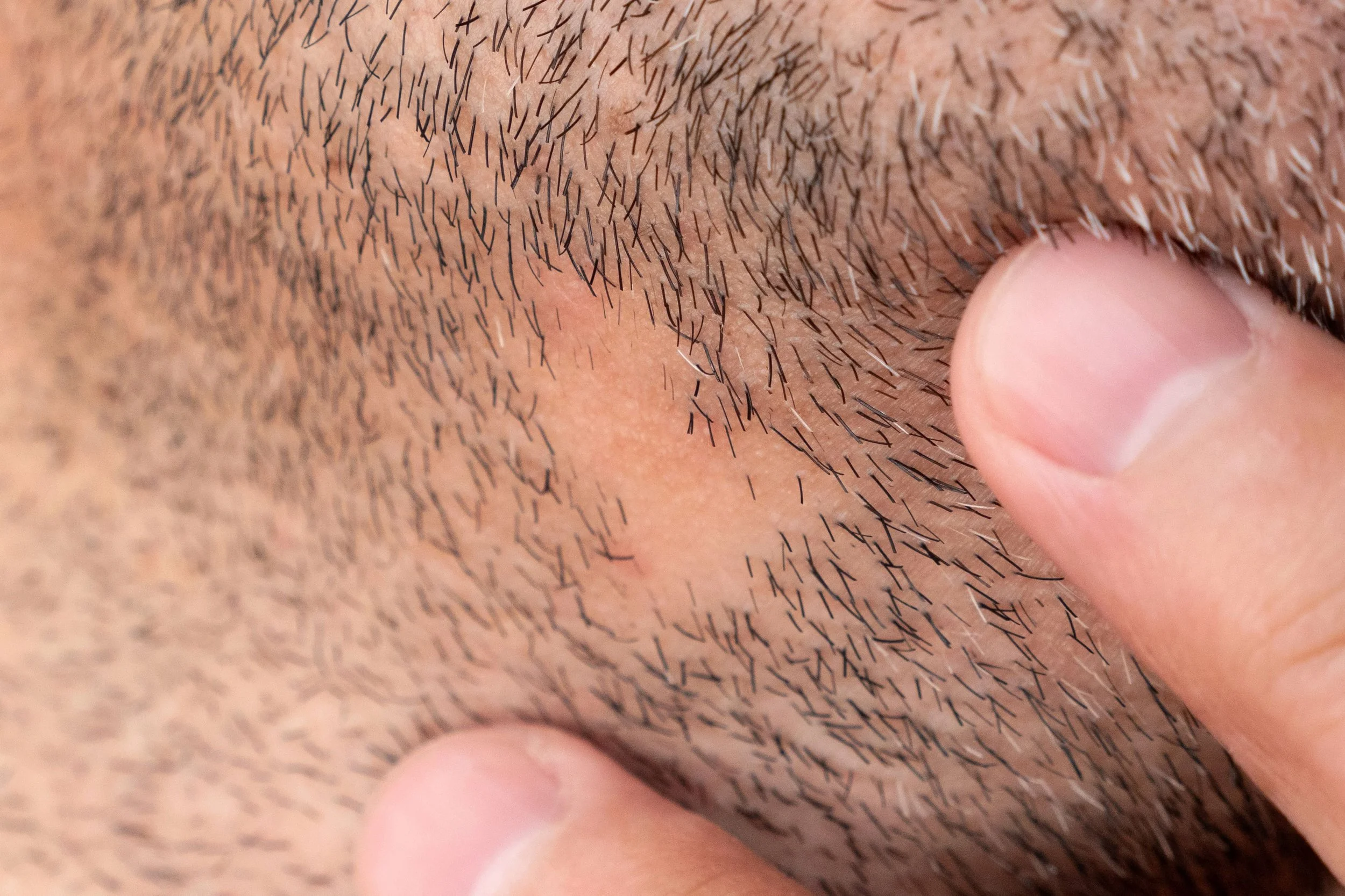 Gros plan d'une peau avec des poils facialement, où une personne tire sur la peau avec le doigt.