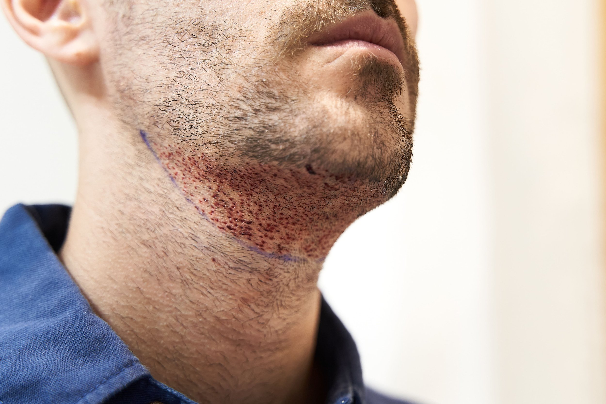 Une personne montre le résultat d'une greffe de barbe, avec une ligne tracée sur le menton et des casques de points de greffe visibles sur la peau.