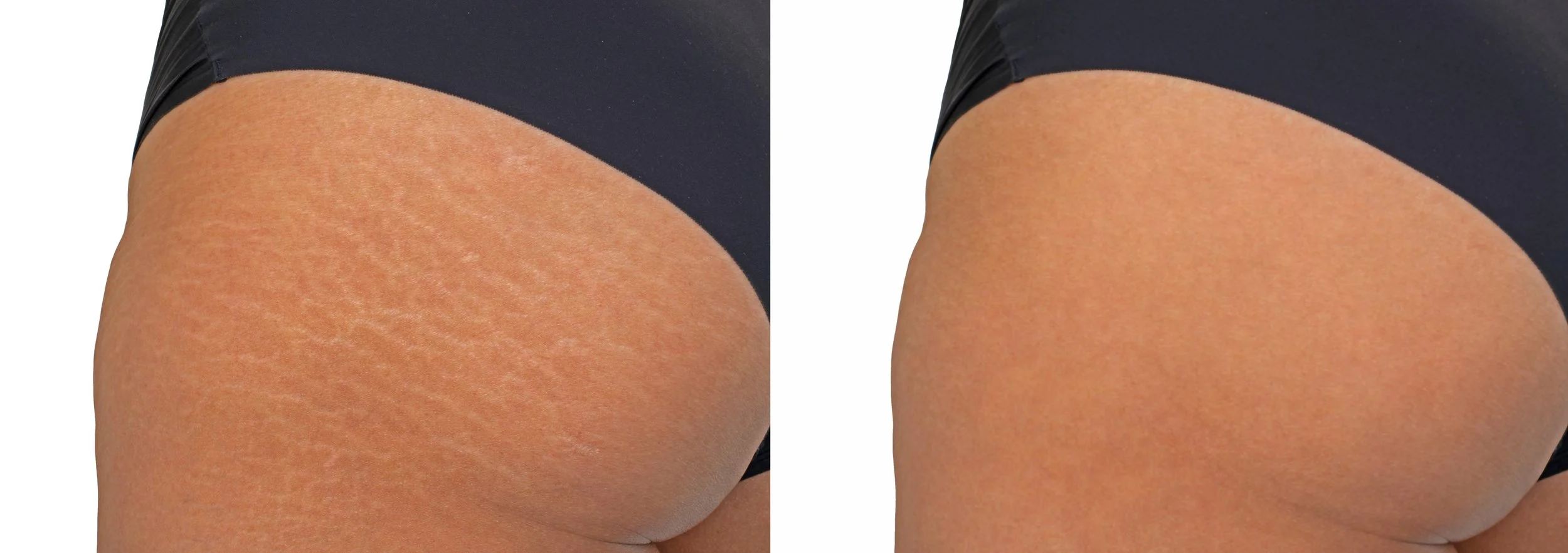 Comparaison entre la peau d'une personne avant et après un traitement pour réduire la cellulite, montrant une peau plus lisse et plus ferme après le traitement.