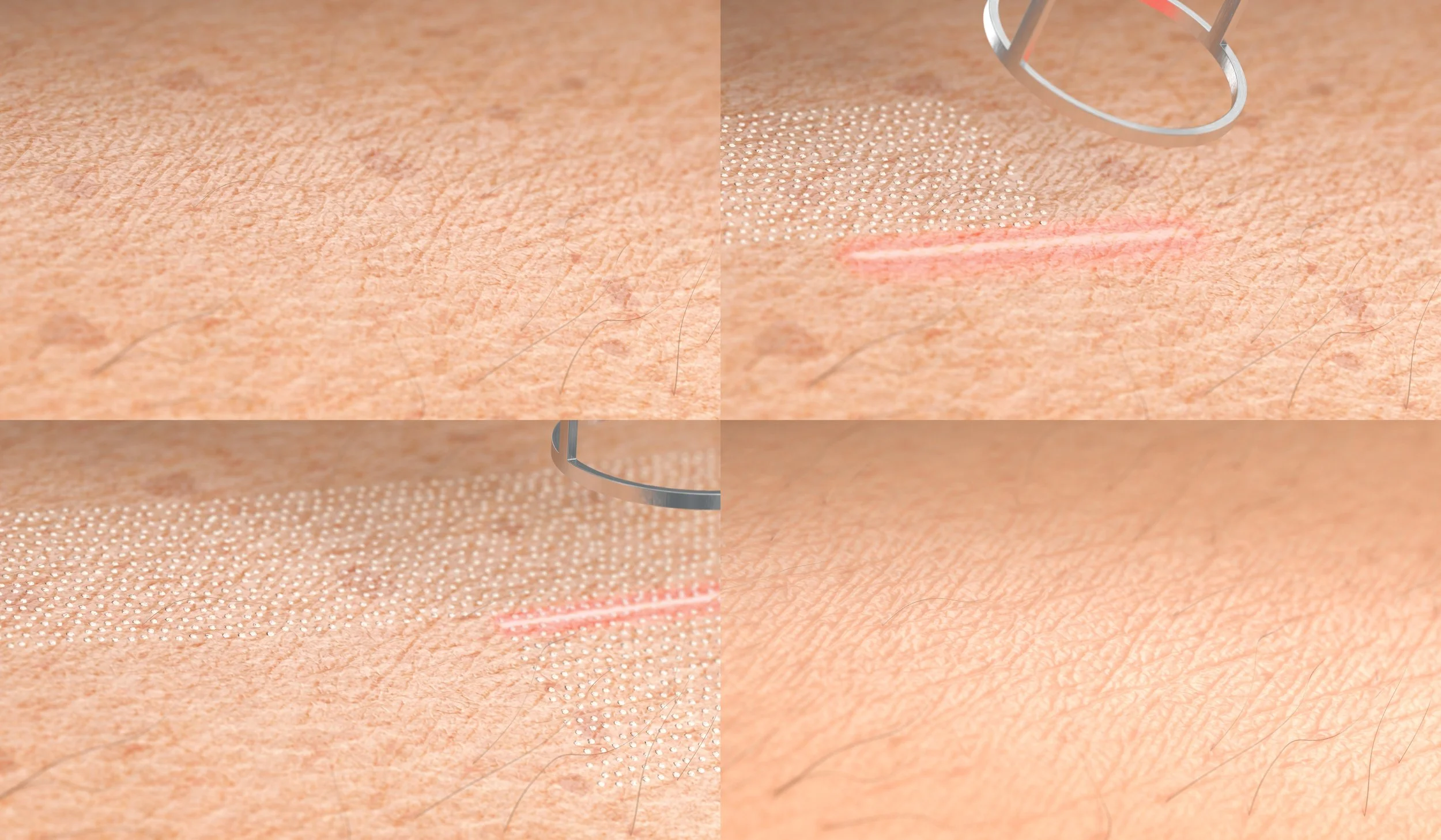 Procédure de traitement de la peau avec laser, montrant un patch de peau avec un laser passant dessus, utilisant un outil circulaire pour le traitement.