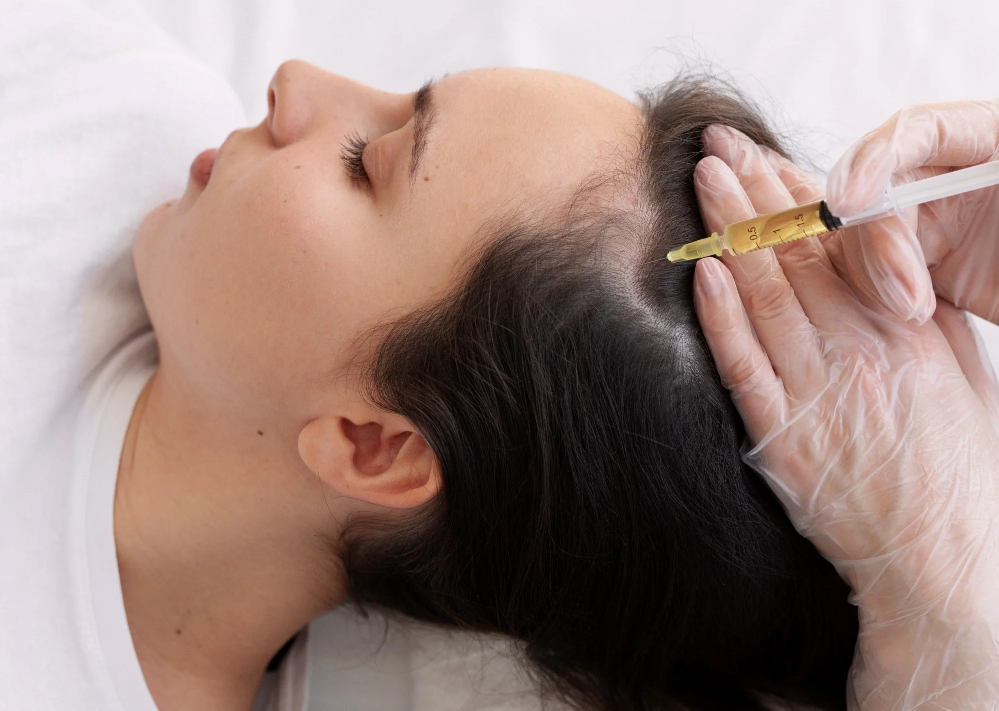 Une personne reçoit une injection dans le cuir chevelu lors d'une procédure médicale ou esthétique.