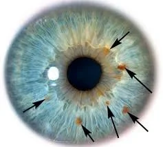 Close-up image of a human eye with labels pointing to various features, including the iris, pupil, and small spots on the iris.