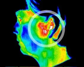 TMJ inflammation