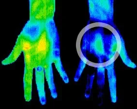 RSD / CRPS sympathetic pain