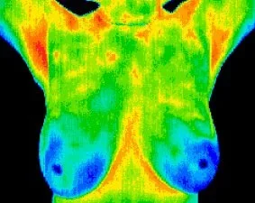 Normal symmetry of healthy breasts.