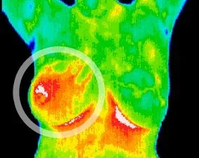 Inflammatory breast disease.