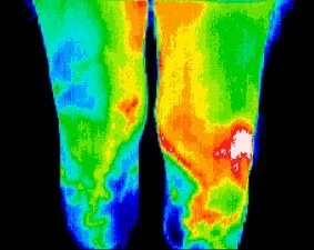 Colorful thermal image of two legs showing heat distribution, with red indicating higher heat and blue indicating lower heat.